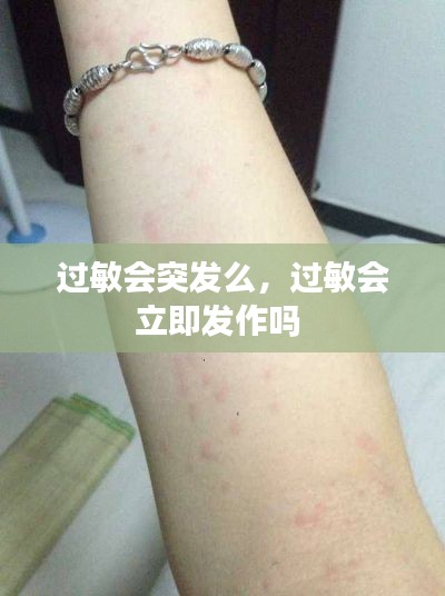 过敏会突发么,过敏会立即发作吗