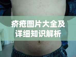 疥疮图片大全及详细知识解析